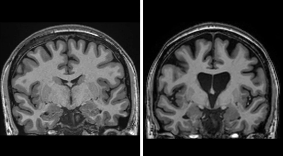 Revolucionarni uspjeh liječnika: "Imamo tretman za jednu od najstrašnijih bolesti"